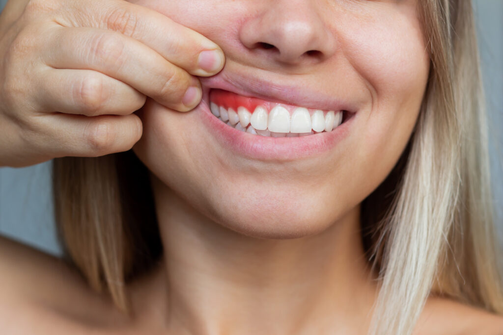 Află cum să tratezi și să previi parodontoza: boala care duce către pierderea dinților