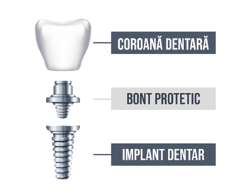 implant dentar componente