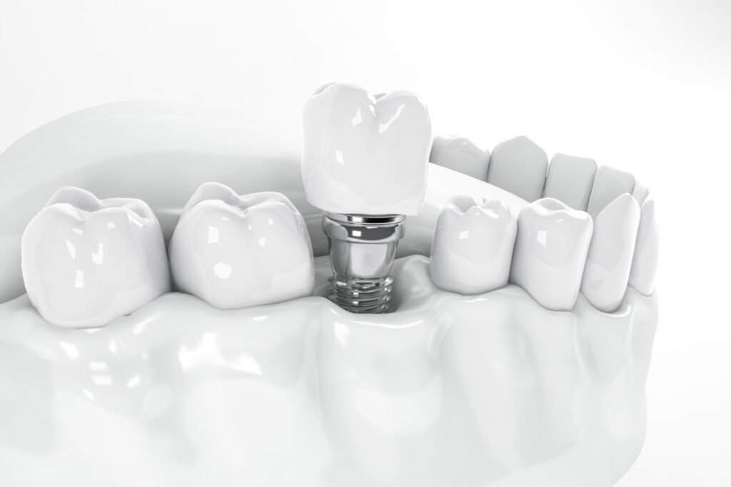 Din ce materiale sunt implanturile dentare?