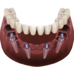 Dinți Ficși pe 4 implanturi