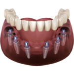 Dinți Ficși pe 6 implanturi